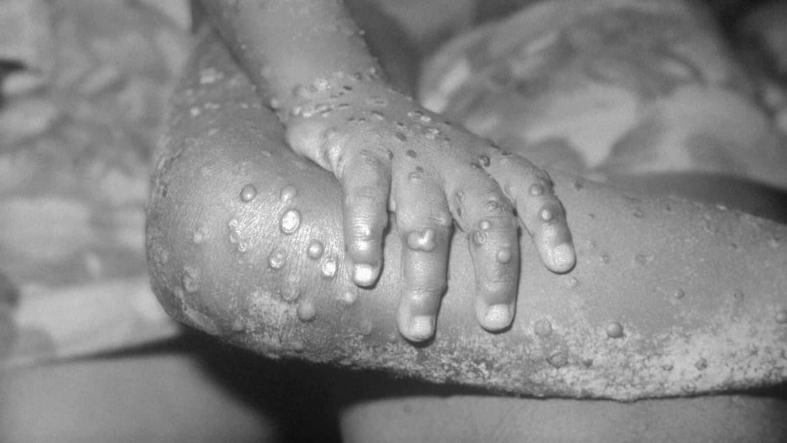 Monkeypox is not the new Covid